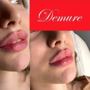 فیلر دمور اولترا 10 سی سی DEMURE ULTRA اورجینال اصلی