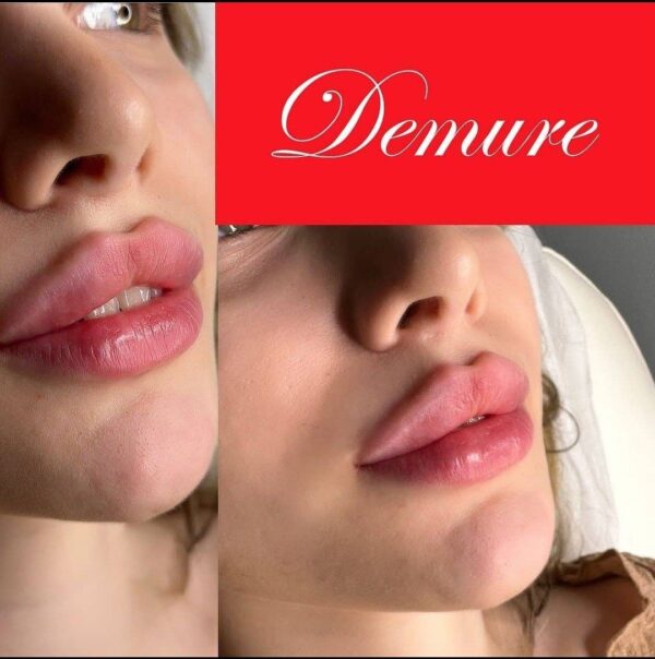 فیلر دمور اولترا 10 سی سی DEMURE ULTRA اورجینال اصلی - Image 2