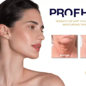 مزو ژل پروفایلو PROFHILO اورجینال شرکتی